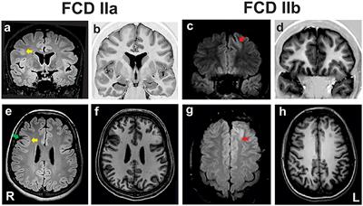 Transcriptome analyses of the cortex and white matter of focal cortical dysplasia type II: Insights into pathophysiology and tissue characterization